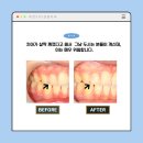 센텀치과기공소 | 둔산동치과 앞니 파절로 상실된 자신감? ' 이것 ' 하나면 하루 만에 감쪽같이 복구!