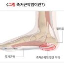 발바닥통증 부위 발바닥통증 원인 증상 치료 걸을 때 발바닥통증 이미지