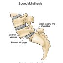 척추 분리증/전방위전위증(Spondylolysis/spondylolisthesis) 동영상 - 국제물리추나학회 이미지