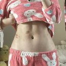 복부 지방분해주사 부작용 유명 다이어트 병원 3회차 비교 후기