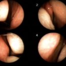 비염침 전후 내시경 사진 비교 이미지