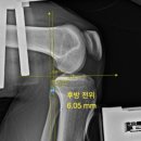 복정형외과의원 | [공지] [ 건강 관리 ] 후방십자인대 손상 후기 | 수술 권유 vs 서울대병원 6mm 진단, 실제 기준은?