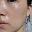 커피피코 - 53043 | 창원피부과 피코토닝후기 화이트닝 잡티레이저추천