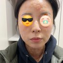 아미스킨명동점 다빼자 시술 솔직 후기 (내돈내산)