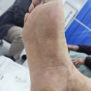 분홍빛으로 병원 | [치료후기]당뇨발 상처! 어떤 병원으로 가야하나 고민이신가요?