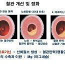 #간경화증 원인과 증상들 이미지