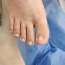 주엽약국 | 일산 발톱무좀 관리 후기, 이번엔 진짜 해결하고 싶어서 찾은 레푸스 주엽점!