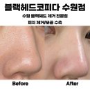 수원블랙헤드 제거 전문점 : 블랙헤드 코피다 수원점