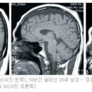 알콜성 당뇨병 이미지