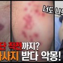 [일반] 절단 직전까지? 마사지 받다 악몽!!! 이미지