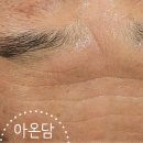 업셀 | 써마지 원리 고주파 탄력 관리｜아온담뷰티 라시뎀 업셀 후기