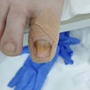 이화의원 | 내성발톱으로 피보고 365이화웃는 세상의원 에서 해결하고온 후기..ㅜㅜ