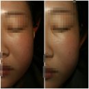 강릉 피부관리 김수정 뷰티어겐 윤곽케어 후기