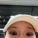담주할머니 | 긴 연휴 맞이 쌍커풀, 눈매교정 절개 수술 후기