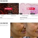 👰🏻‍♀️스드메 준비 ▶잠실 피부과 세르프 300샷+레드터치프로 후기｜써마지 고민하다 세르프로 결정...