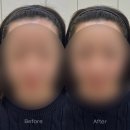 까까로운 | [군자역] 조이로운 자연스러운 헤어라인 솔직 후기 | 헤어라인 잘하는곳