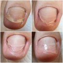군포산본 발톱무좀 문제성발톱 레푸스 오블리네일N뷰티샵 레진젤 HF관리 후기