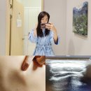 송도유외과의원 | 지방종 제거 병원 어깨 등에 혹 인천 송도유외과로 결정