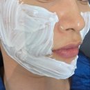 강남 신논현역 비올라셀성형외과 에서 울쎄라 300샷 시술 리얼 솔직 후기 (내돈내산) 한달차 후기...