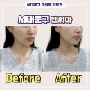 가좌역 3번출구 | 고주파로 피부 탄력을 끌어올리는 텐써마 리프팅 콜라겐 재생 효과 부작용 가격 후기 통증 - 가좌역 피부과