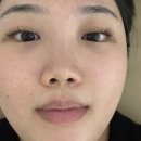 센텀피부관리 유담에스테틱 여드름관리 후기