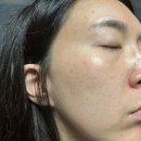 순수클리닝 | 기미클리닝 꿀동안앰플로 홈케어 완성 인디레이저 사용 후기