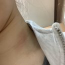 임약국 | 이유없이 올라오는 두드러기, 피부 가려움, 발진(최정선피부과의원/온누리임약국)