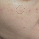 빨리팔아 | 부천 피부과 리쥬란 내돈내산 후기 발품팔아 찾아간 곳