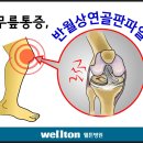 [관절경수술잘하는곳,무릎연골수술] 관절경수술잘하는곳의 관절내시경을 이용한 무릎연골수술 이미지