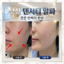 알파양산 - 양산시 양산역4길 13 | 부산 덴서티 알파 통증 써마지와 비교 / 양산 피부과 내돈내산후기 / 40대리프팅추천