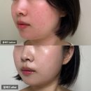 청담 피부과 울쎄라 300샷 효과 후기 - 통증, 다운타임 없었음!