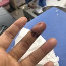 (주)에스씨 | 손가락 끝 골절 봉합 회복 과정 흉터 연고 추천 후기