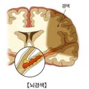 [퍼온글] 뇌졸중(대뇌혈관 질환) 이미지