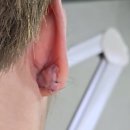 늘푸른미치과의원 | 귀 켈로이드 수술 후기 _#내돈내산 #부산