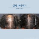 신정동권샘내과의원 | 양천구탈모치료, 정수리·M자까지 진행된 남성형 탈모도 다시 자라날 수 있을까?