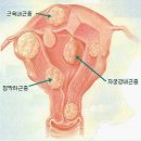 uterine myoma(자궁근종) 이미지