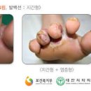 무좀 증상과 원인, 치료 방법은? 발톱, 발, 발가락, 발바닥 이미지