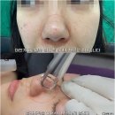 히트성형외과의원 | 울트라클리어 가격 흉터 모공 후기 개선 방법 원리