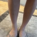 젠틀엠 | 일산 레이저제모 젠틀맥스프로플러스 종아리 제모 5회차 완료 내돈내산