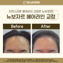 경대뉴보자르의원 | 💇‍♀️ [시술후기] 경대뉴보자르의원 헤어라인 교정으로이마 라인부터 인상이 달라졌어요!