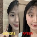 쿨타임 | 압구정 피부과 다운타임 없다고? 쿨소닉 리프팅 솔직 후기