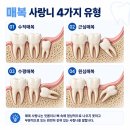 신호드림치과의원 | 정왕동치과 잘하는곳, 사랑니 발치 준비 가이드