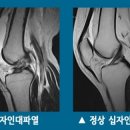 십자인대 파열시 치료방법은? 이미지