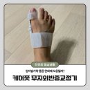 케어풋 무지외반증교정기 직접 착용 후기, 오른발 변화 기록