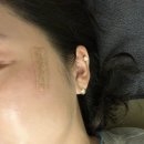 인계동 순복음교회뒤 | 수원흉터제거시술 솔직후기 |새살침 &amp; 코라테라피 후기기록 (feat. 수원흉터제거 1회차)