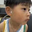 (주)텍코드 | 41개월 아기 스킨텍 제거 레이저시술 ( 일산동국대학교병원성형외과 )