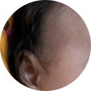 에스앤유피부과 - 성남시 분당구 황새울로200번길 9-7 | 아기 화염성모반·음낭 혈관종 진료 후기(마포공덕에스앤유 피부과에서 첫진료 및 약 처방 후 치료시작)