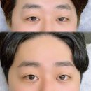 일산 남자 관리 애교살 애굣살 반영구 리얼후기 ㅣ식사동 아이브