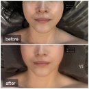 에스테티아천안신불당 | 천안 웨딩케어 에스테틱 에스테티아 천안신불당1호점 상체윤곽관리 후기