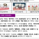 기존에 치료받은 크라운, 브릿지, 임플란트 등을 수리하거나 대체하는 경우에는 보험금을 지급받지 못합니다 이미지